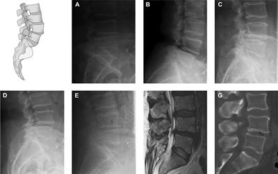 Intermodal Detection of Lumbar Instability in Degenerative Spondylolisthesis is Superior to Functional Radiographs